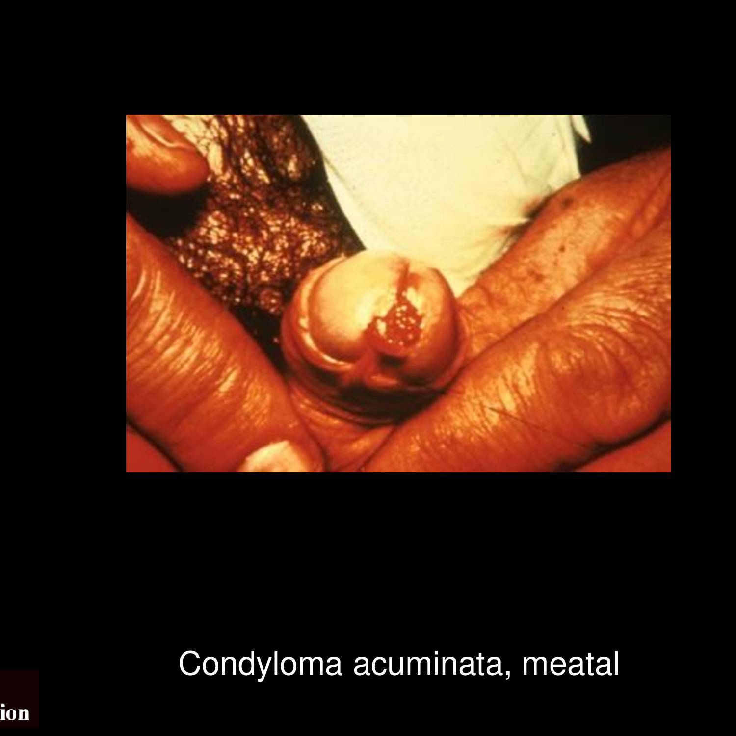 Vulvar condyloma acuminata lesions on female external genitalia showing multiple flesh-colored papular wart-like growths